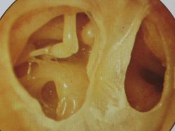 Chronische Mittelohrentzündung mit Löchern im Trommelfell | Dr. Schuster