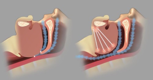 Öffnung der Atemwege durch Revent Gaumensegel-Zungen-Implantationssystem