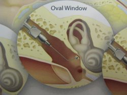 Fully Implantable Hearing Aid