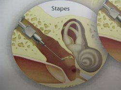 Fully Implantable Hearing Aids