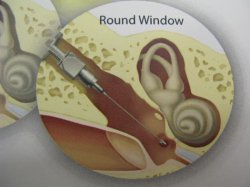 Implantable Hearing Aids