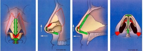 Nose Surgery